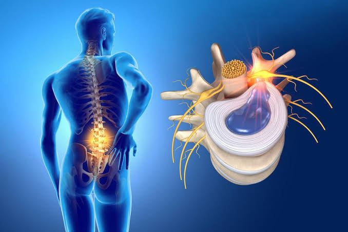 hernia de disco lumbar